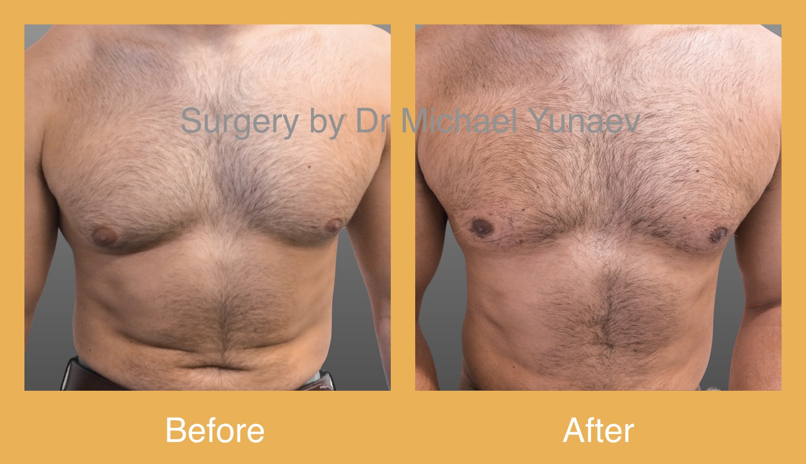 Surgical male breast reduction, surgery results 01, BB Clinic 