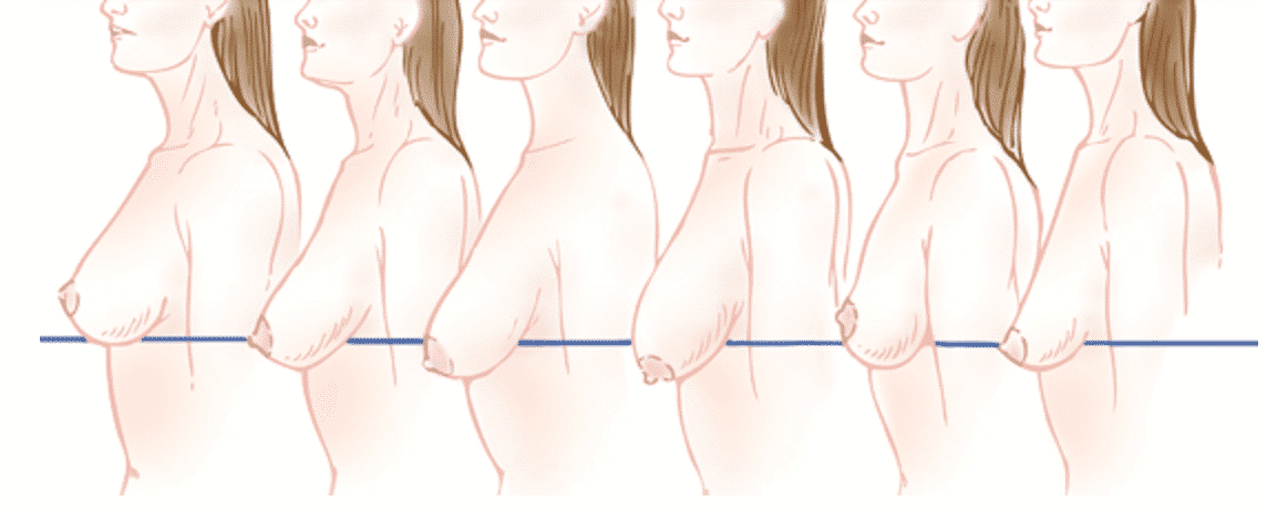 Understanding When You Need A Breast Lift Mastopexy, Not Just A Breast Augmentation Mammoplasty | 3