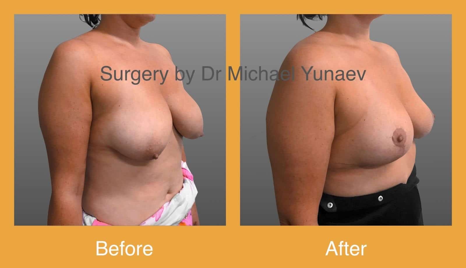 The Non-Surgical Breast Lift Mastopexy and Its Limitations | 1