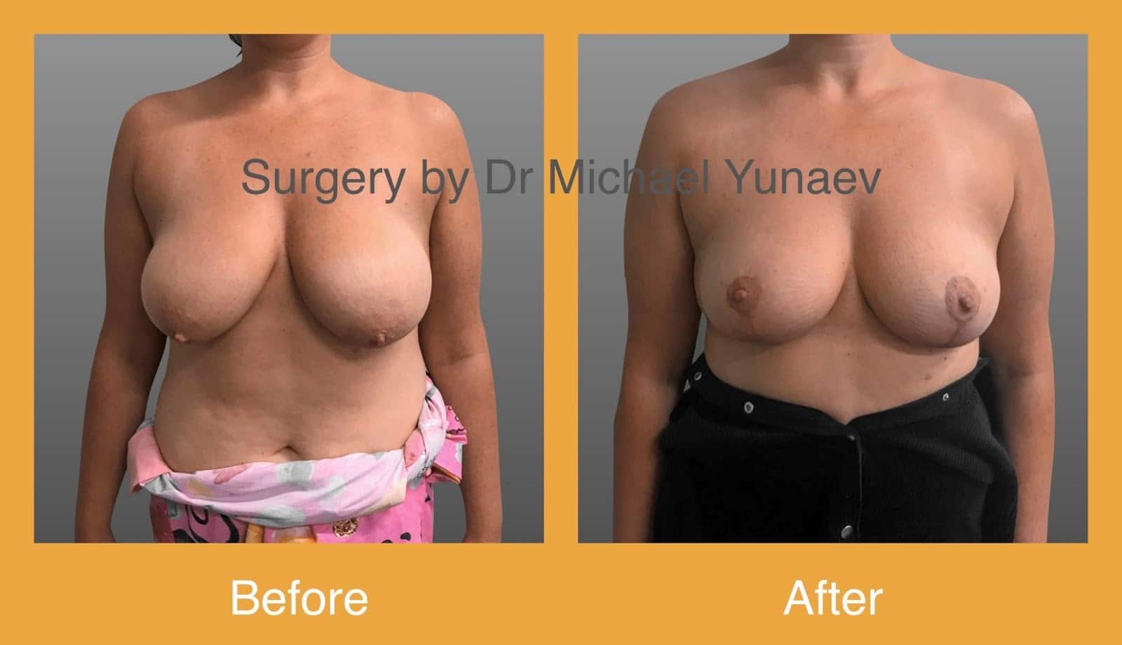 Understanding When You Need A Breast Lift Mastopexy, Not Just A Breast Augmentation Mammoplasty | 2