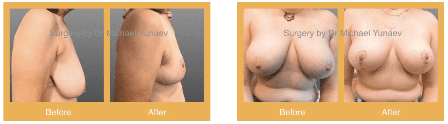 Breast reduction results with Dr Yunaev 02 (before and afters)