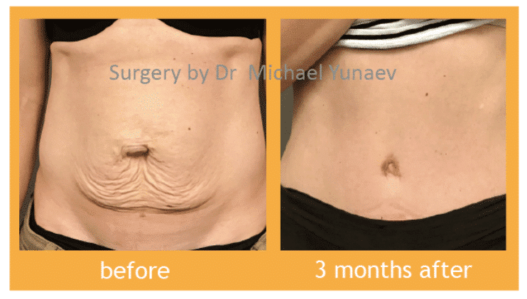 Tummy tuck before and after 04, abdominal plastic surgery results, BB Clinic blog