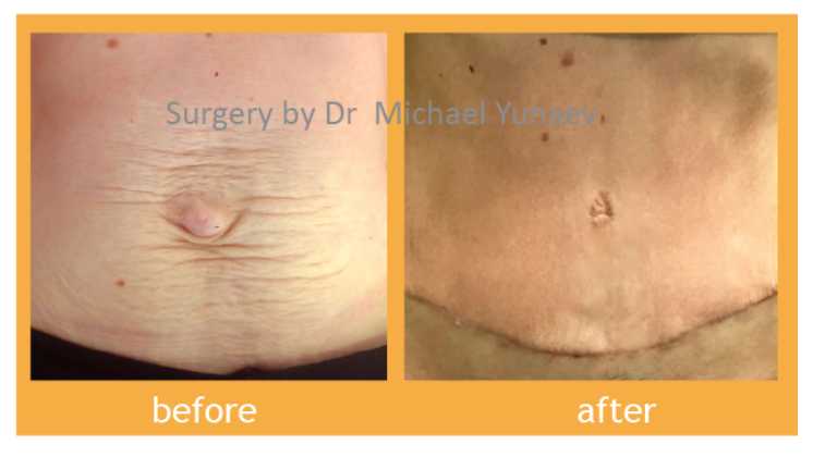 Tummy tuck blog, before and after 02, BB Clinic