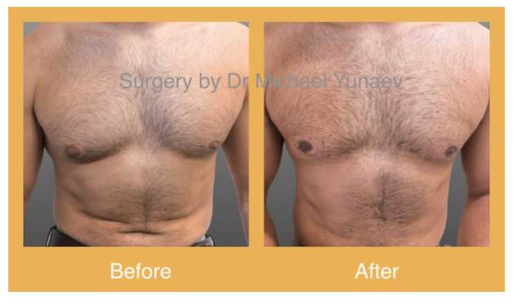 Will My Gynaecomastia Be Treated Without Surgery, surgery results 01, BB Clinic Sydney