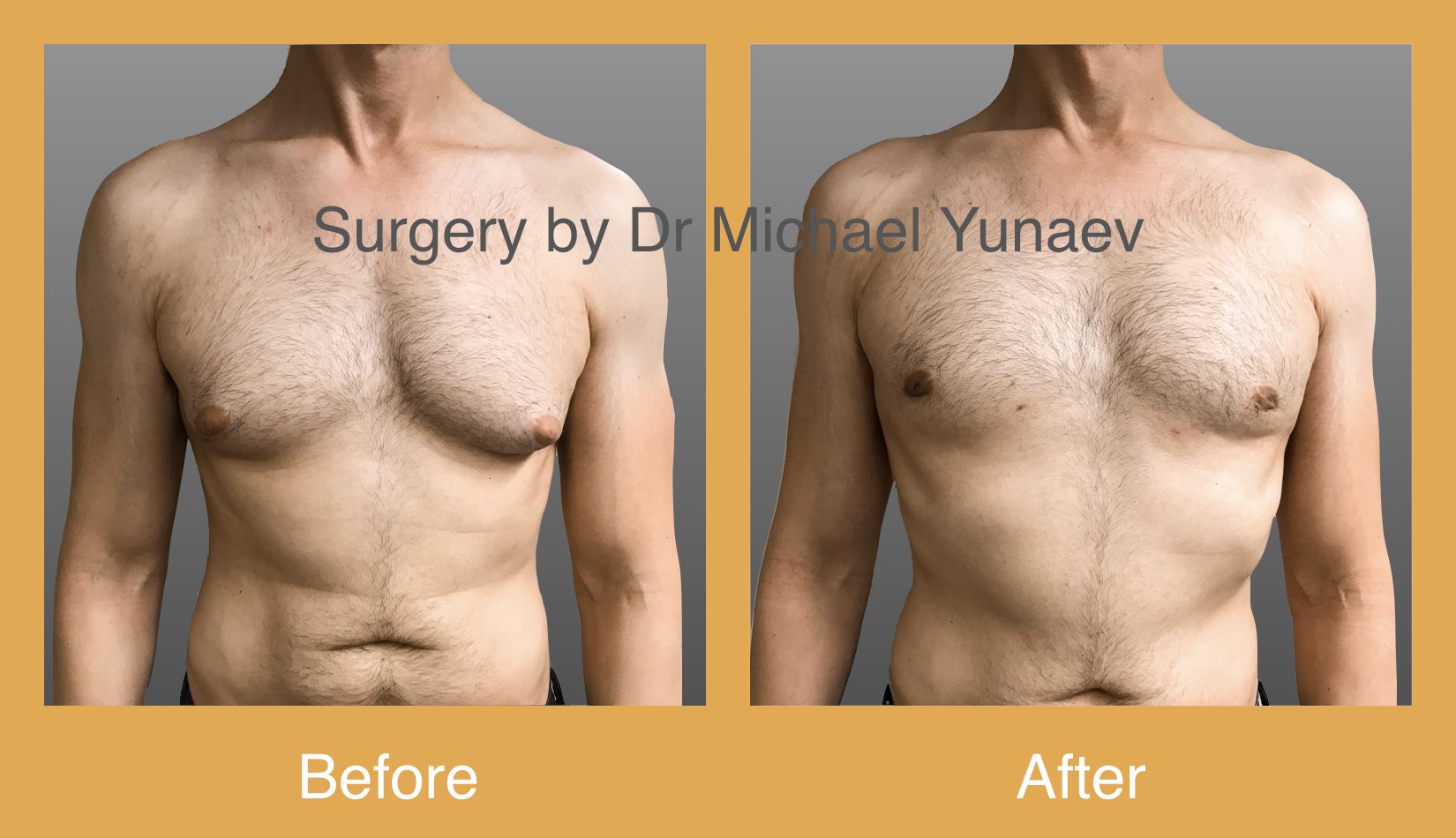 How Common Is Gynaecomastia, before and after 01