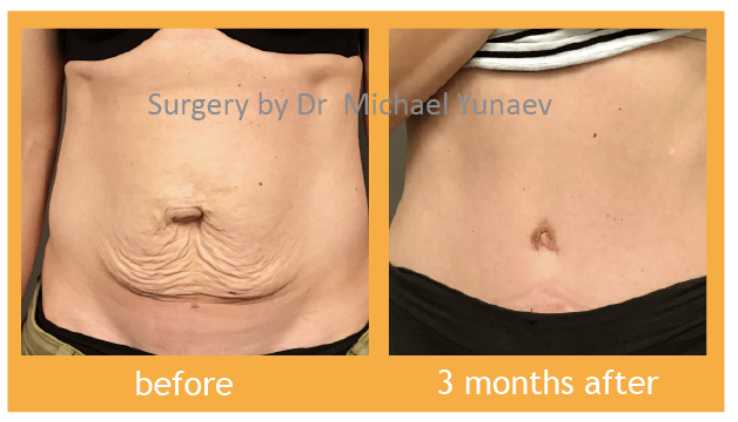 Tummy tuck before and after 3 months 01,  Dr Yunaev Sydney
