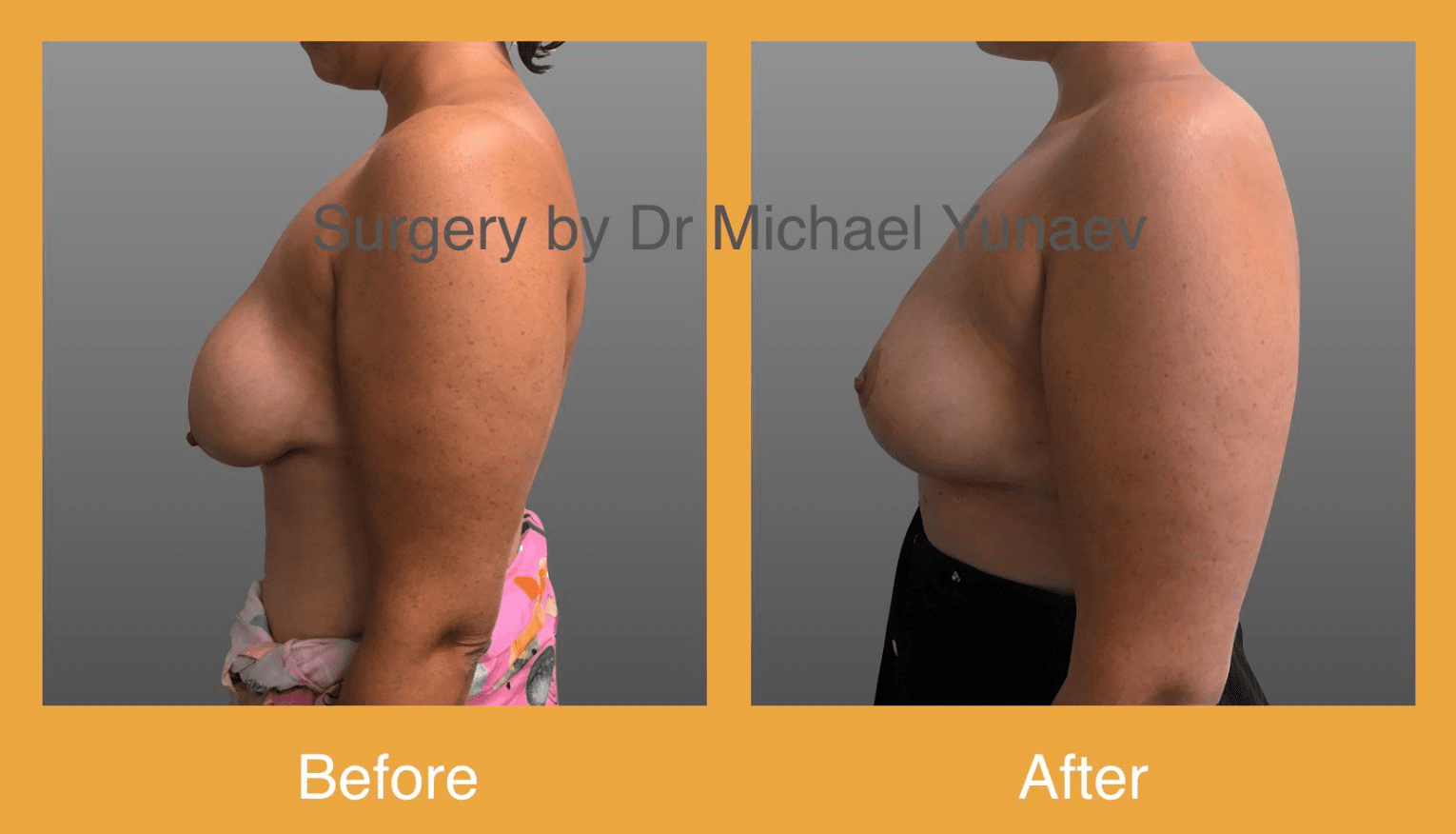 Breast lift surgery in Sydney, before and after01, Dr Yunaev