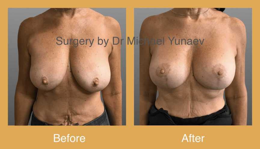What Is a Breast Lift Mastopexy and What Is Involved With It? | 2