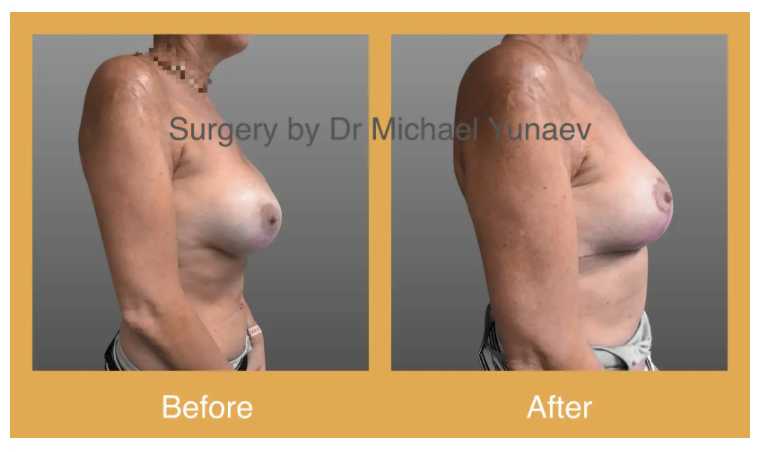 How Long Does It Take to Recover from Breast Revision Surgery? | 2