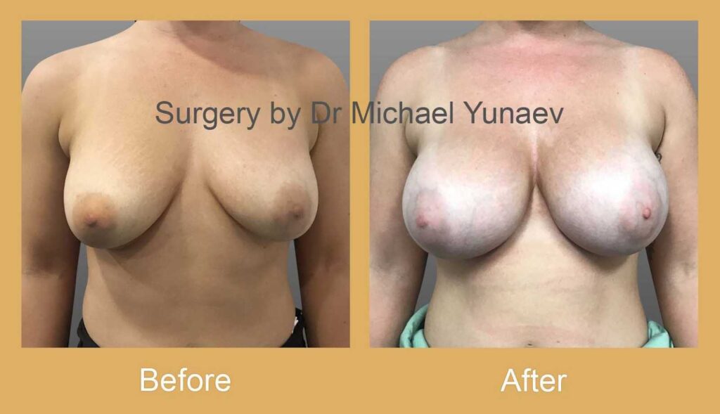 How Long Does It Take to Recover from Breast Revision Surgery? | 1