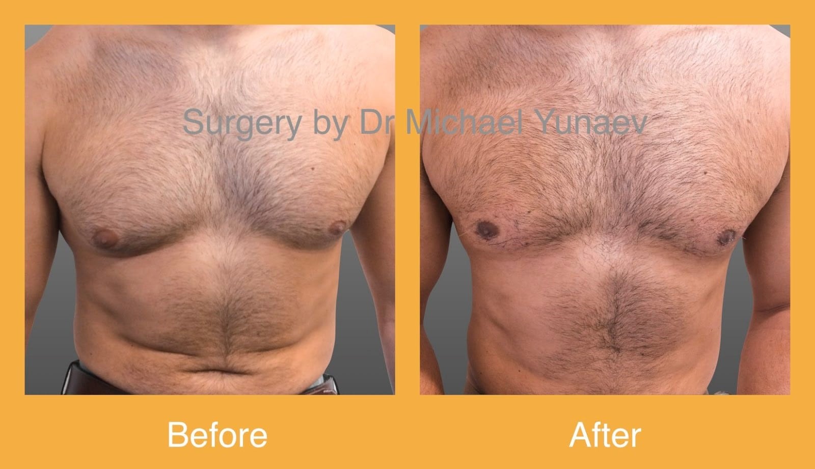 Man boobs surgery before and after 01, surgery for Gynaecomastia at BB Clinic in Sydney