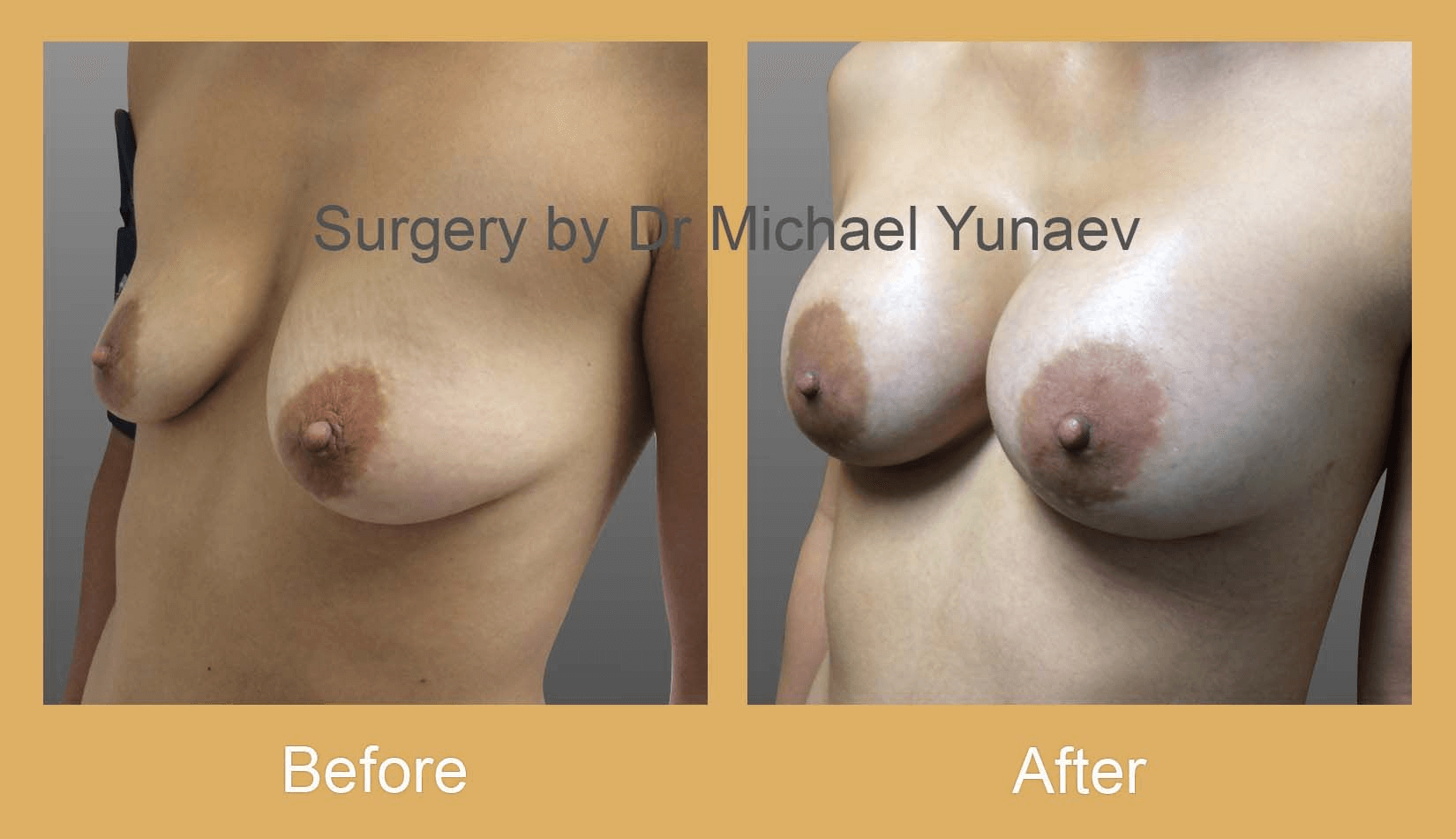 scarring after breast augmentation surgery