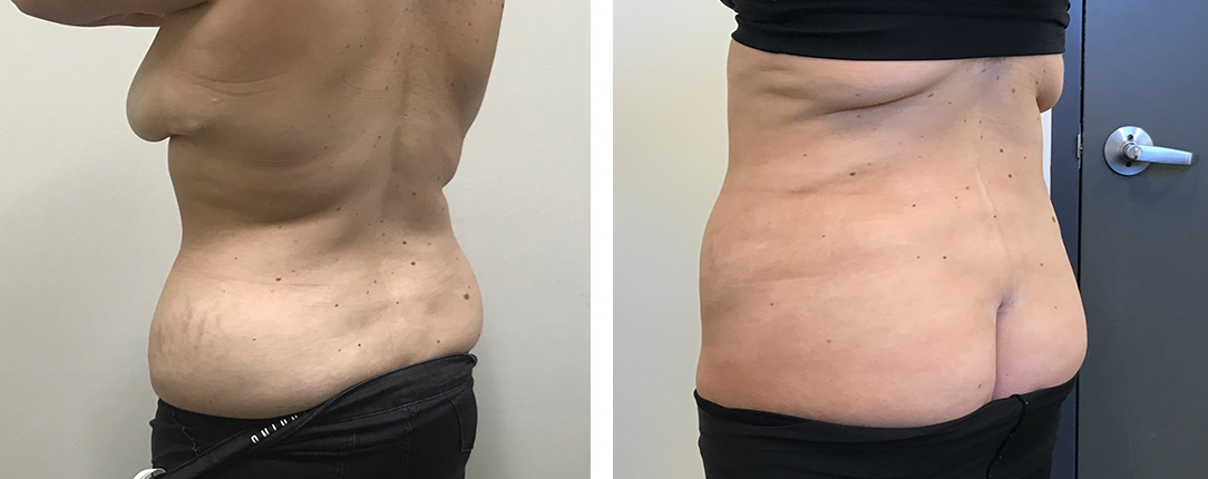 Is Post-Weight-Loss Surgery Covered by Medicare? 1 liposuction-patient-D-6