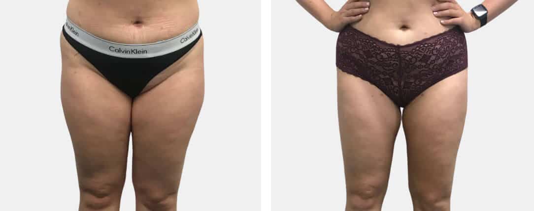 Liposuction results in BB Clinic Sydney 02