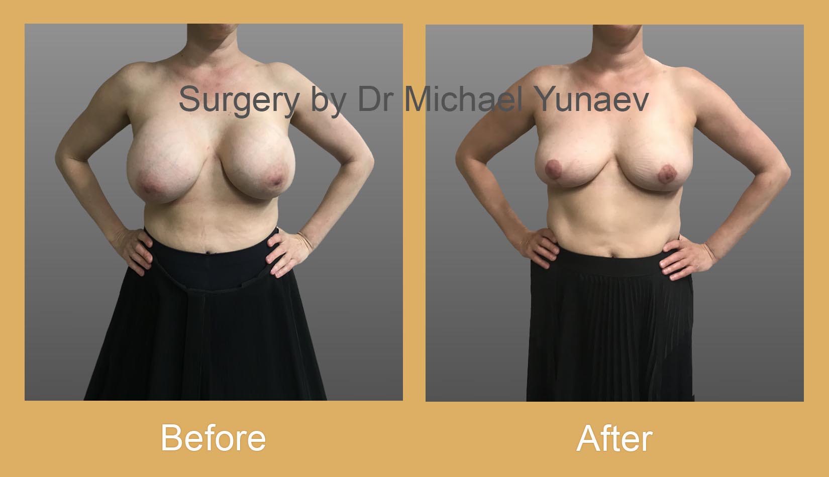 Breast Implant Removal Cost in Australia: What You'll Pay in 2026 1 breast-implant-removal-with-breast-lift-before-and-after-camperdown
