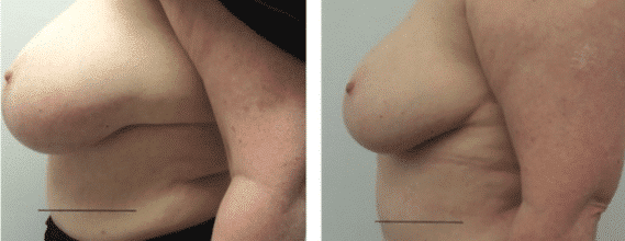 Breast Liposuction Reduction