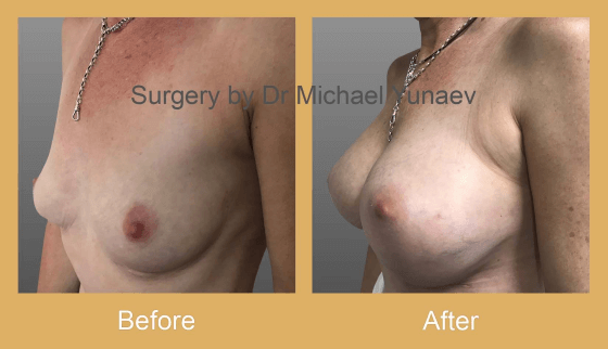 Cosmetic & Reconstructive Breast & Body Surgery Procedures in Coffs Harbour & Sawtell