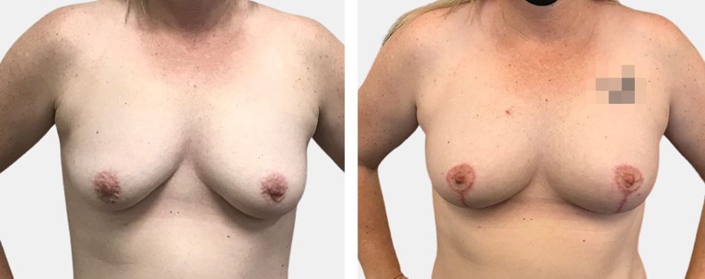 Breast Lift With Fat Transfer