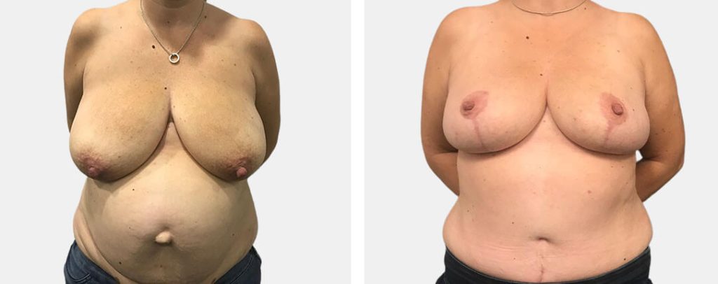 Mummy Makeovers (Combined Breast and Abdomen Surgery) Sydney