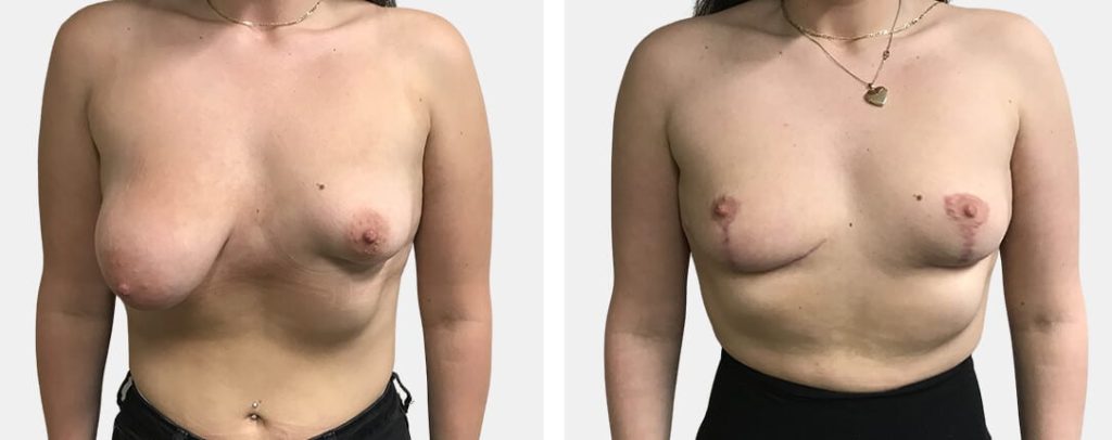 Tuberous Breast Correction Without Implant