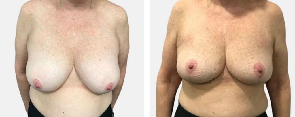 Breast Lift With Implants