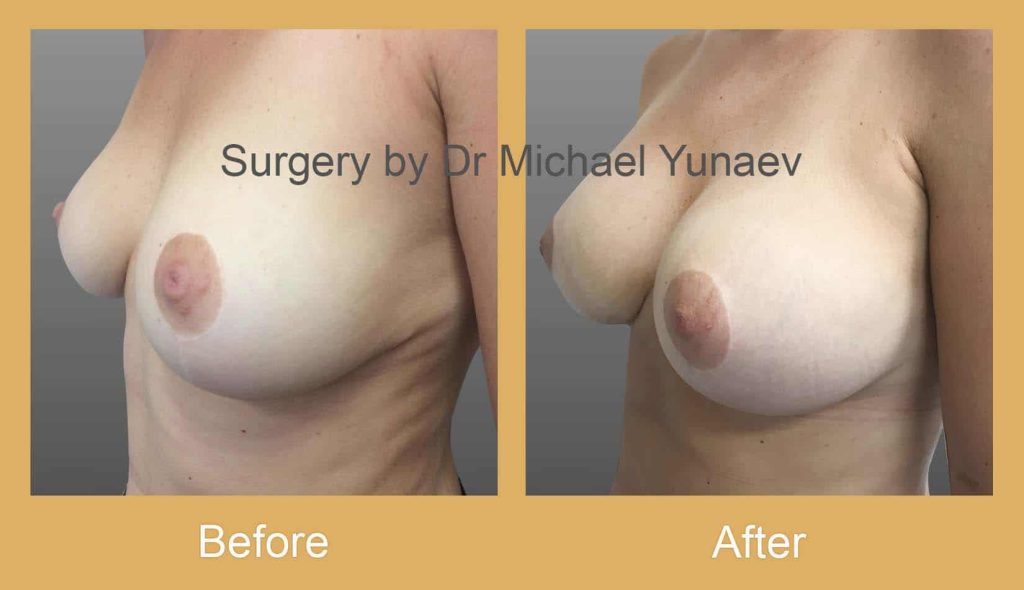 Cosmetic & Reconstructive Breast & Body Surgery Procedures in Tweed Heads