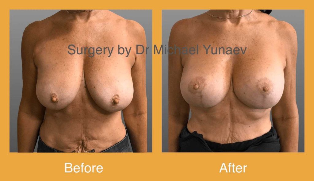 Cosmetic & Reconstructive Breast & Body Surgery Procedures in Wollongong