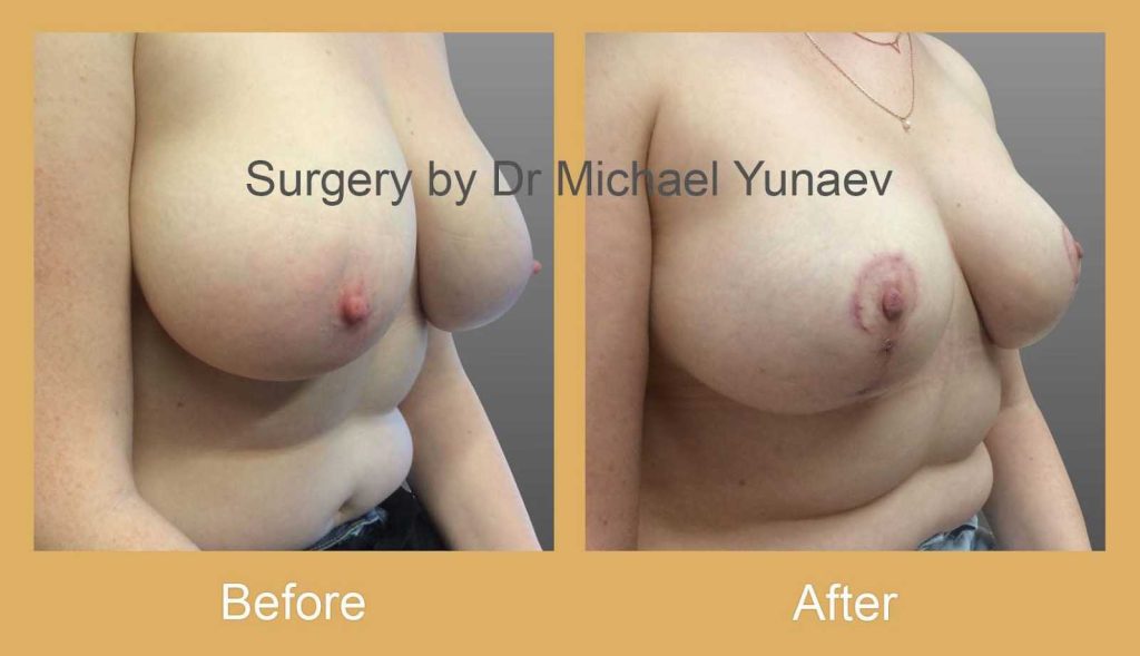 Cosmetic & Reconstructive Breast & Body Surgery Procedures in Wagga Wagga