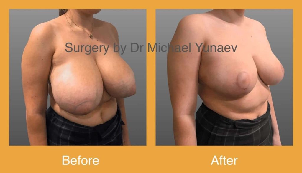 Cosmetic & Reconstructive Breast & Body Surgery Procedures in Albury