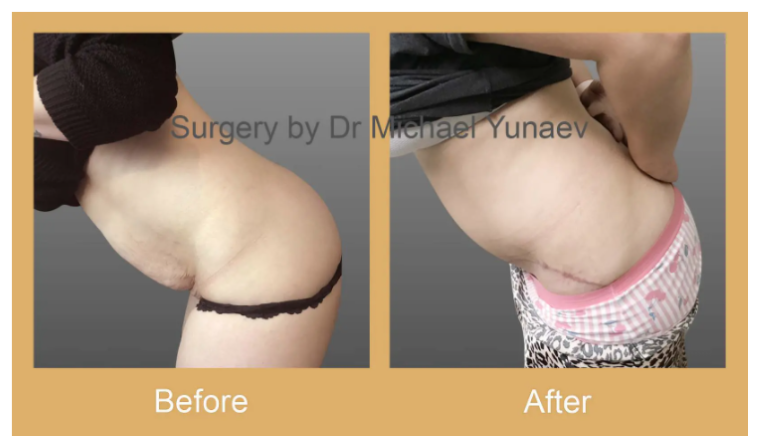 Cosmetic & Reconstructive Breast & Body Surgery Procedures in Dubbo
