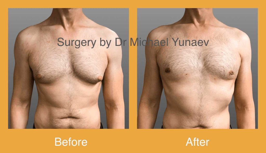 Cosmetic & Reconstructive Breast & Body Surgery Procedures in Wollongong