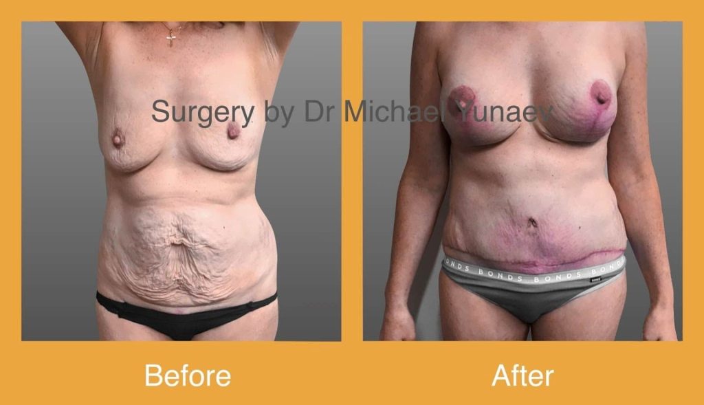 Cosmetic & Reconstructive Breast & Body Surgery Procedures in Albury